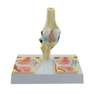 Rheumatic Knee Joint Model
